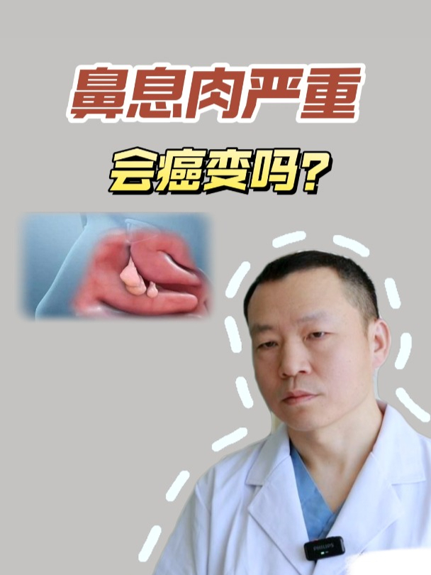 鼻息肉患者必看:癌变风险大揭秘!