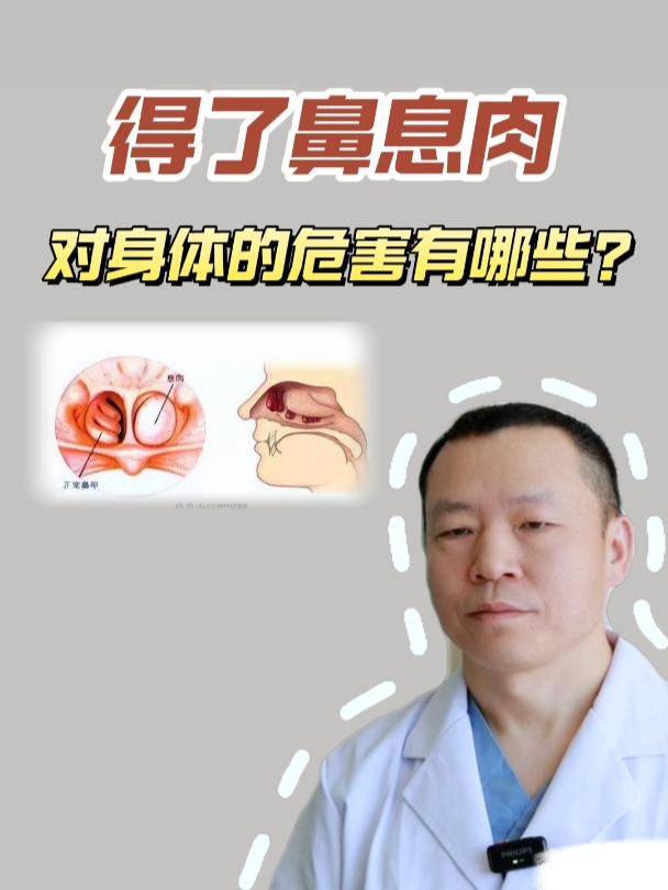 鼻息肉的危害,你了解多少?