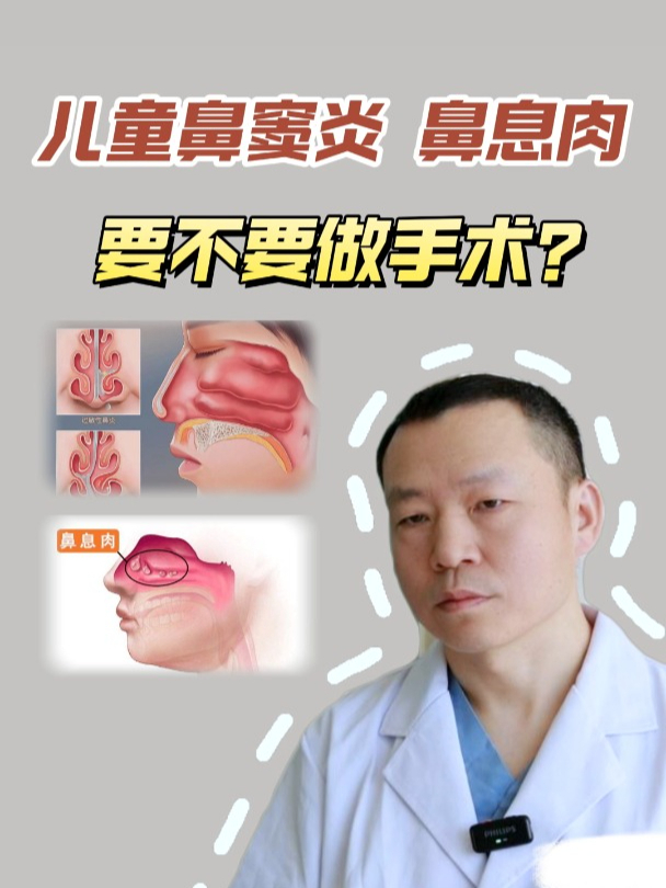 儿童鼻窦炎鼻息肉,手术与否的终极解答!