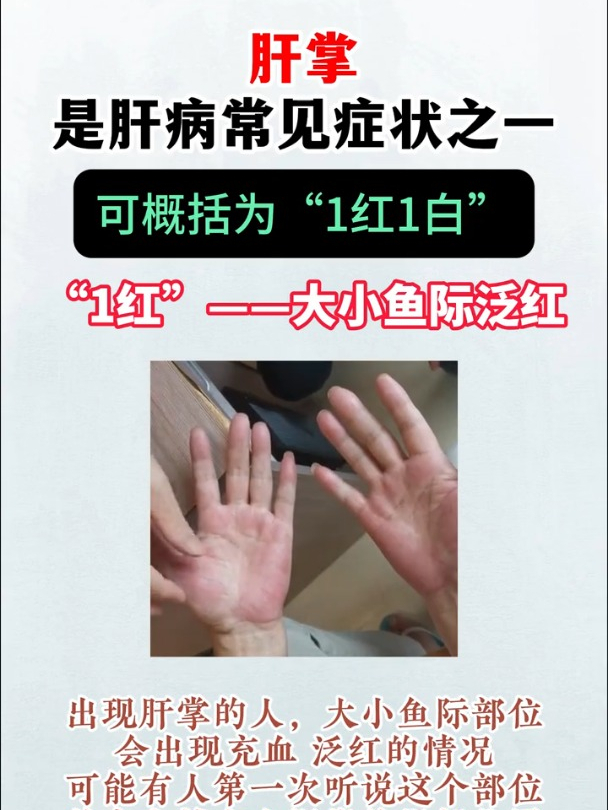 肝掌是肝病常见症状之一,可概括为“1红1白”!