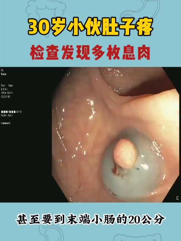 30岁小伙肚子疼,检查发现多枚息肉