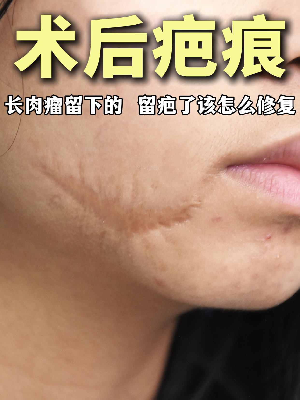 嘴角肉瘤术后疤痕,怎么修复平整?