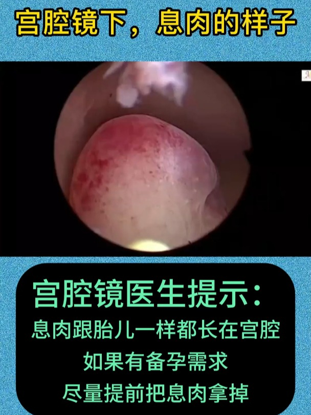子宫异常出血,宫腔镜下息肉的样子