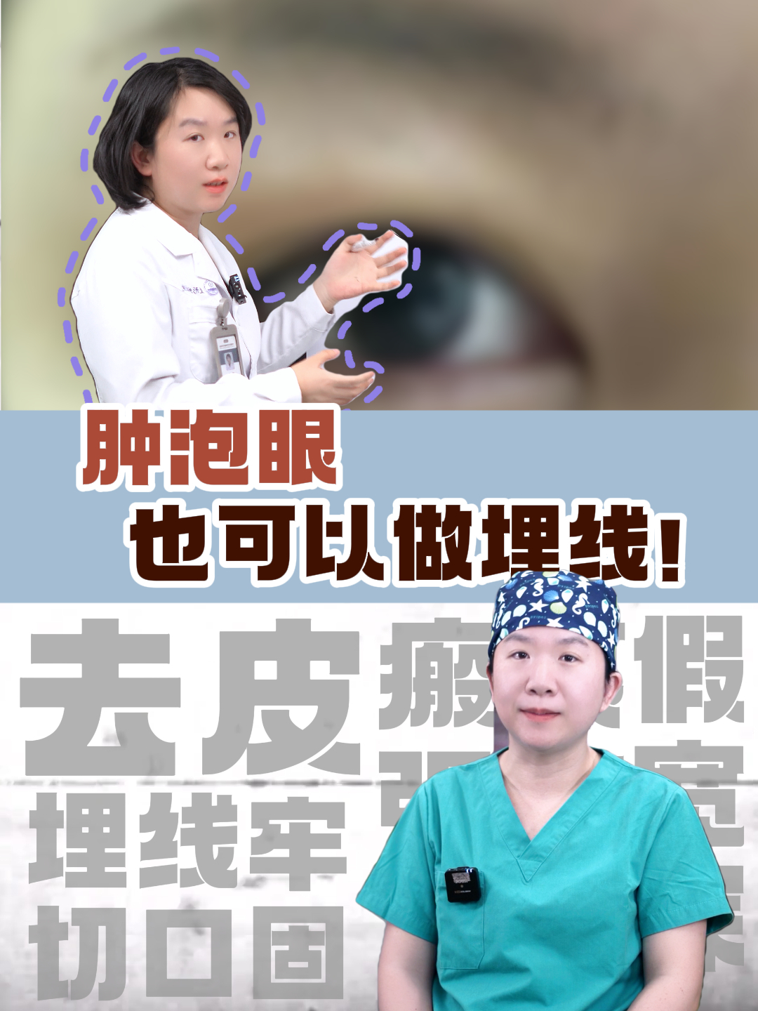 谁说肿泡眼不能做埋线的!