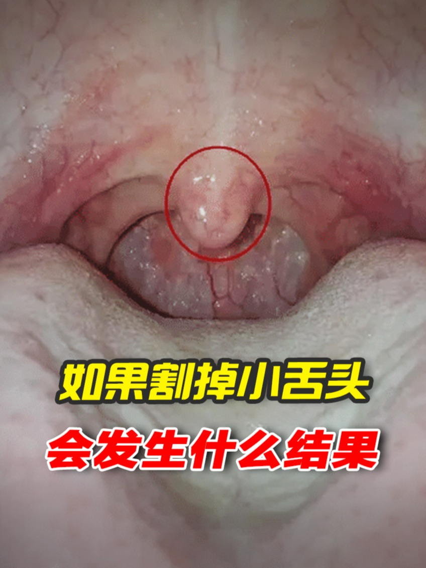 嗓子那的“小舌头”,悬雍垂到底有啥作用?割掉的话会影响什么