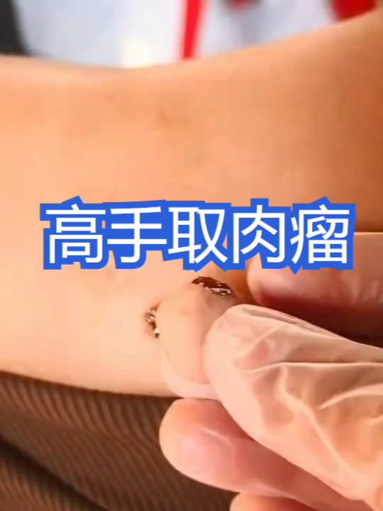随手取肉瘤