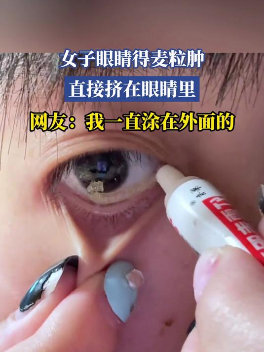女子眼睛得麦粒肿，直接挤在眼睛里，网友：我一直涂在外面的