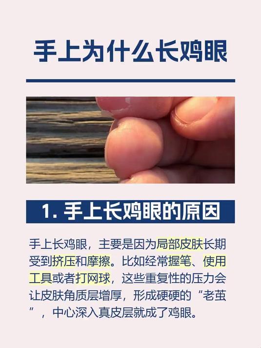 手上为什么长鸡眼