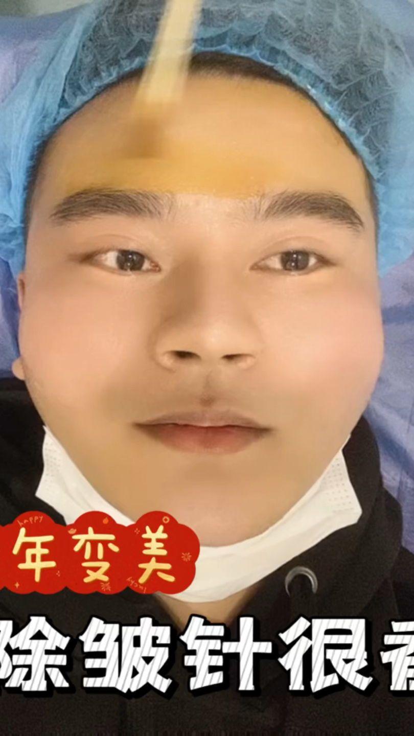 除皱针除皱效果好吗?