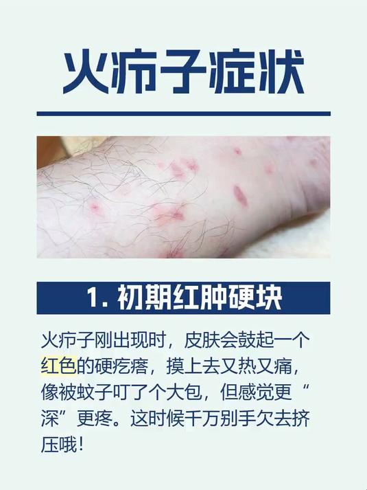 #马上健康过大年#火疖子症状