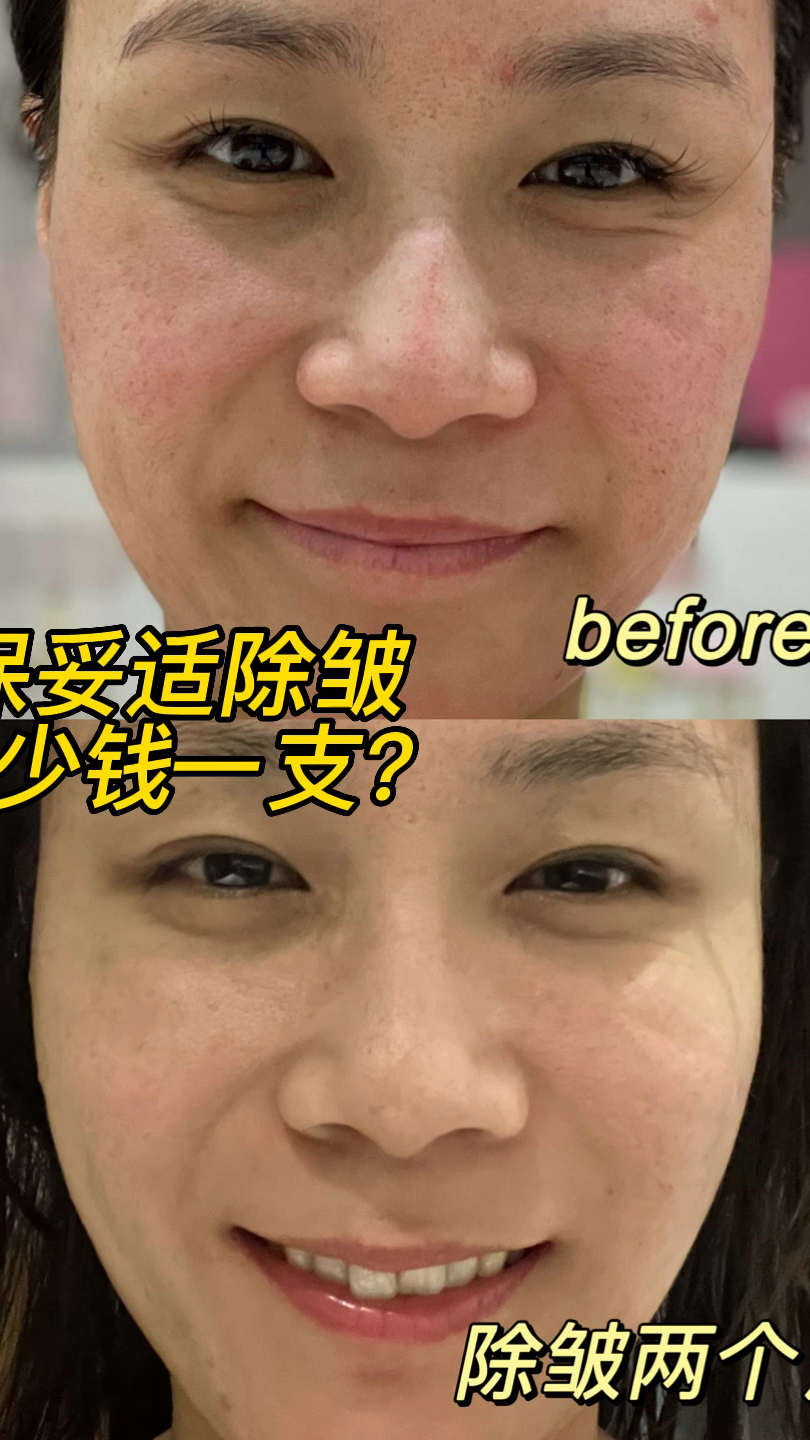 保妥适除皱多少钱一支?