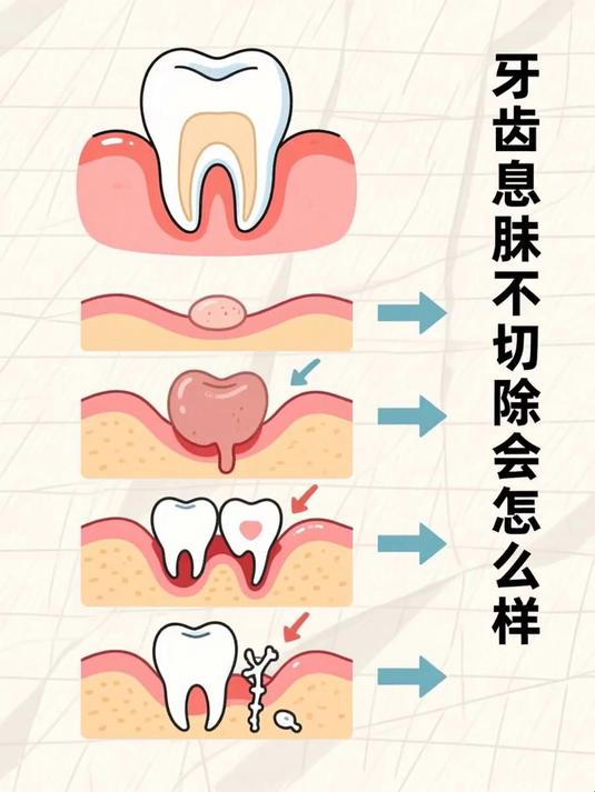 牙齿息肉不切除会怎么样 #健康扬帆季#