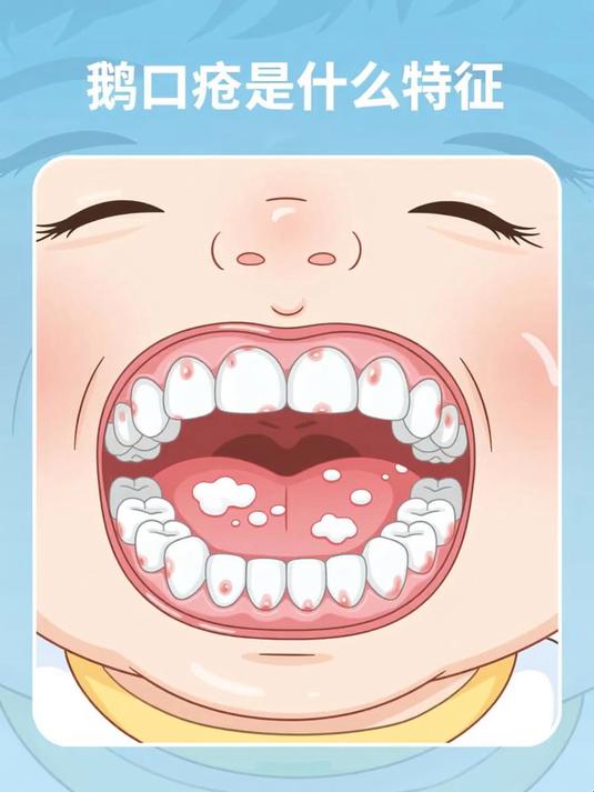 鹅口疮是什么特征