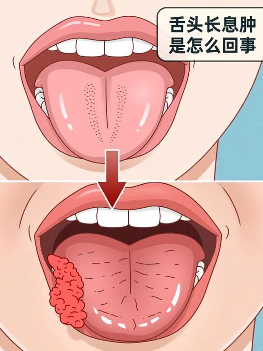 舌头长息肉是怎么回事