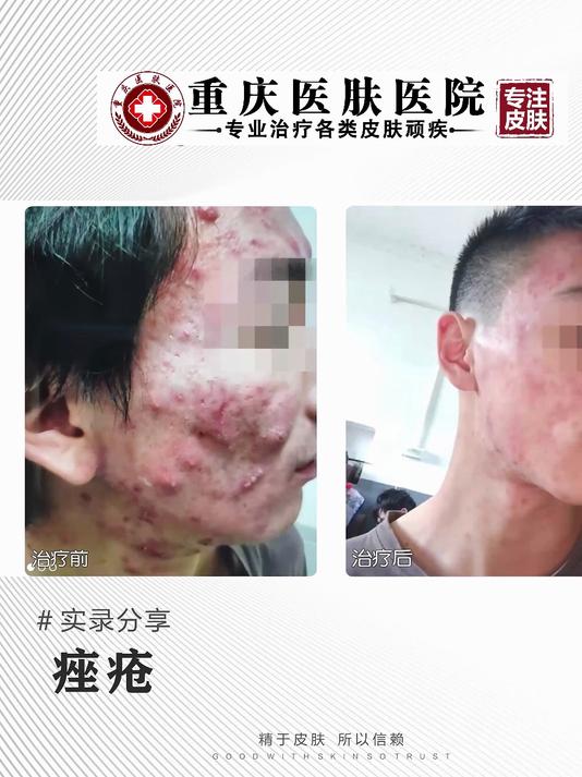 重庆皮肤科医院排名第一-重庆医肤医院-专业治疗痤疮医院痤疮