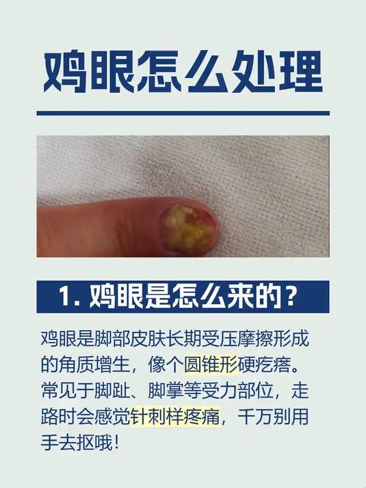 鸡眼怎么处理