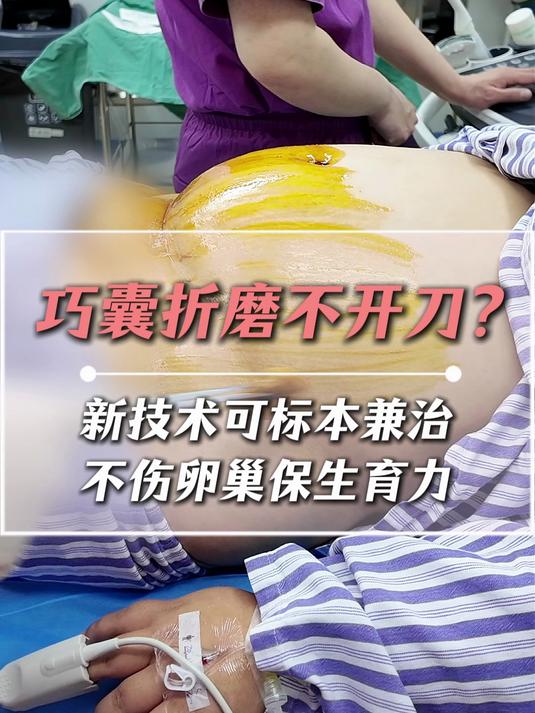 #巧克力囊肿#女性健康#痛经 #医学科普