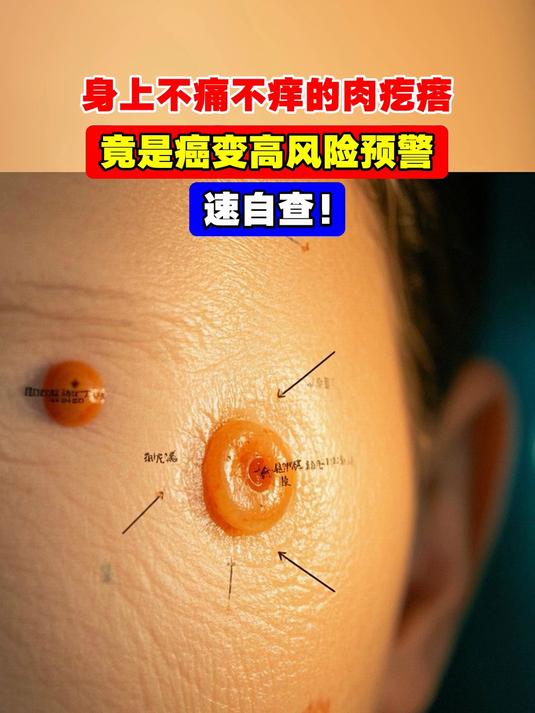 身上不痛不痒的肉疙瘩，竟是癌变高风险预警，速自查！