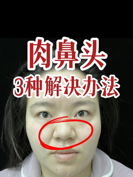 鼻头大,肉鼻头3种解决办法讲解!