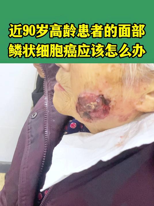 近90岁高龄的患者,面部长了鳞状细胞ai应该怎么办