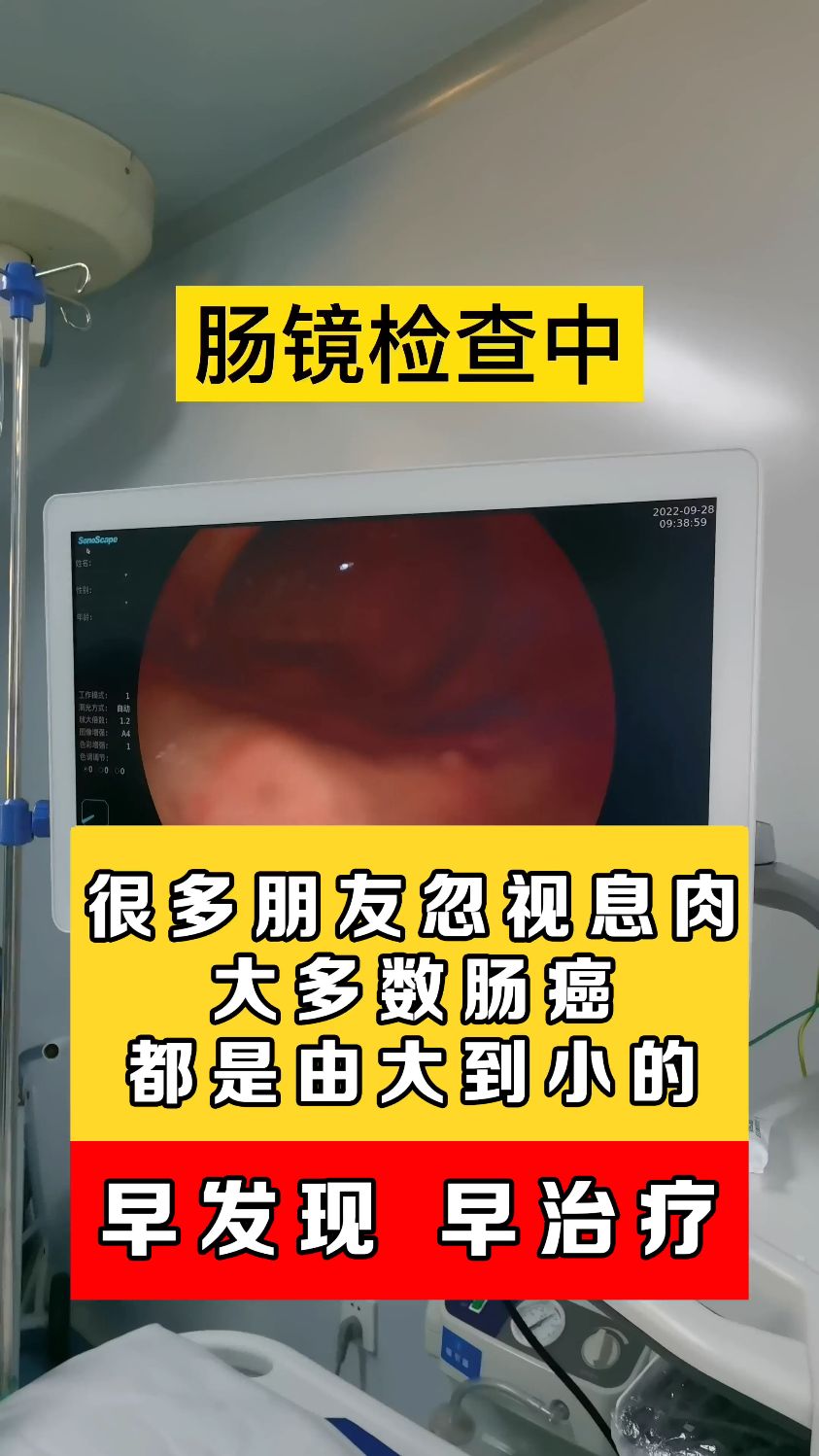 肠镜检查的时候遇到这种小息肉千万不能忽视,任其发展的话,可能会变成早期结肠癌!