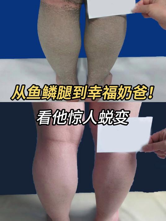 从鱼鳞腿到幸福奶爸！看他惊人蜕变