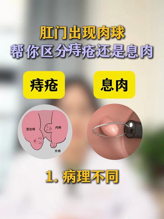 肛门出现肉球,教你区分痔疮还是息肉#痔疮##内痔##外痔#