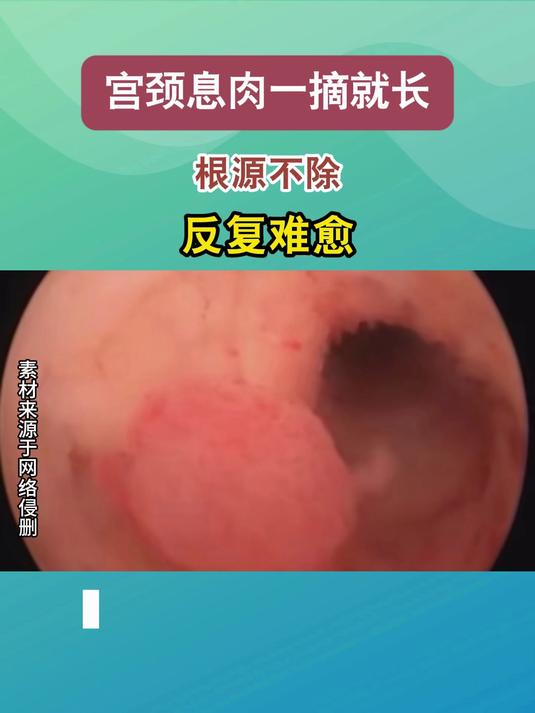 宫颈息肉一摘就长?根源不除,反复难愈#健康向阳计划#
