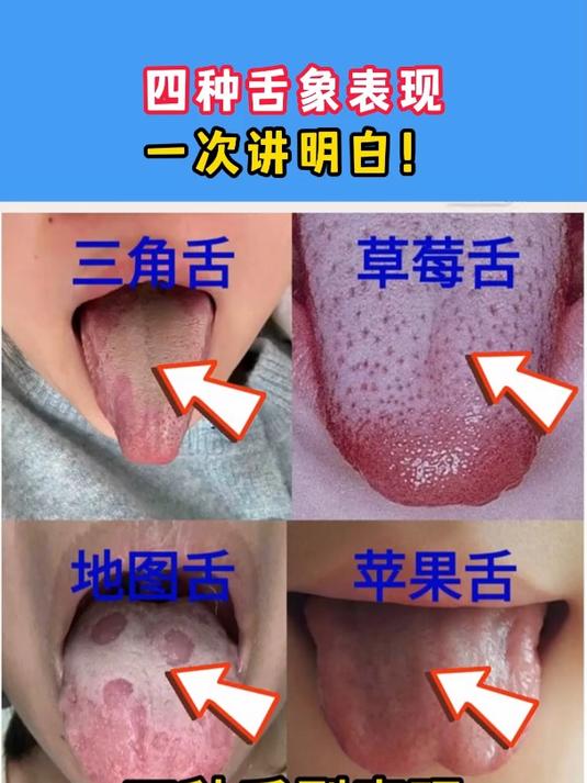 四种舌象表现,一次讲明白!
