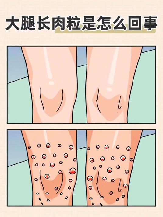 大腿长肉粒是怎么回事 #健康扬帆季#