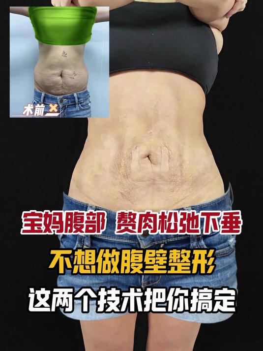 宝妈腰腹部赘肉多皮肤松弛下垂,不想做腹壁整形,如何去改善