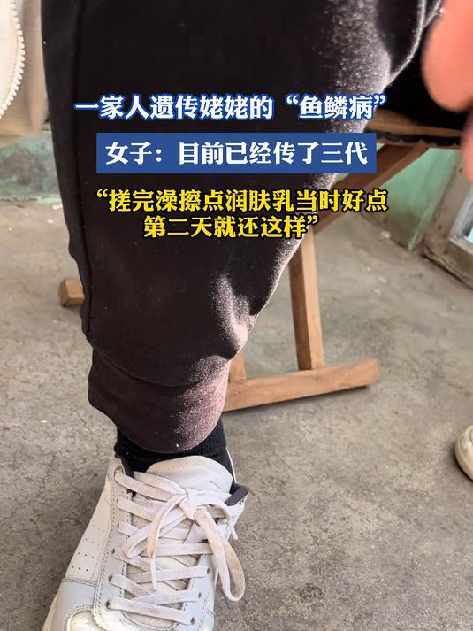 一家人遗传姥姥的“鱼鳞病”,女子:目前已经传了三代,搓完澡擦点润肤乳当时好点第二天就还这样