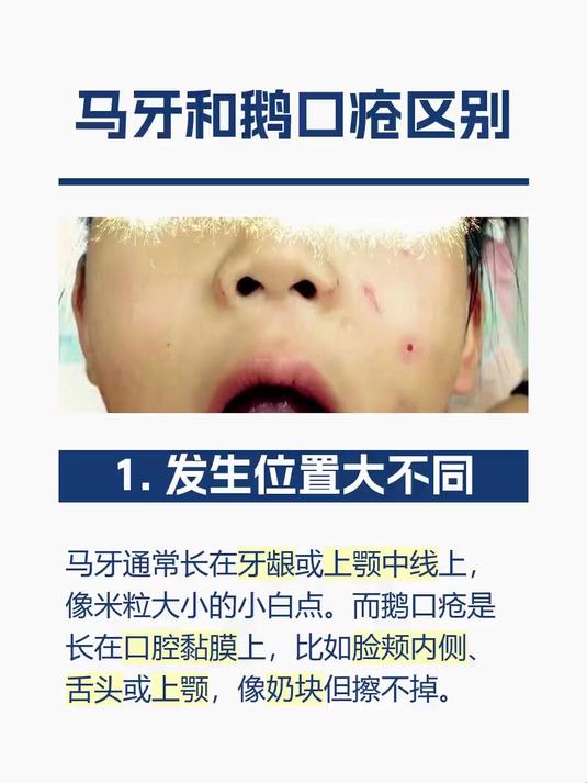 马牙和鹅口疮区别