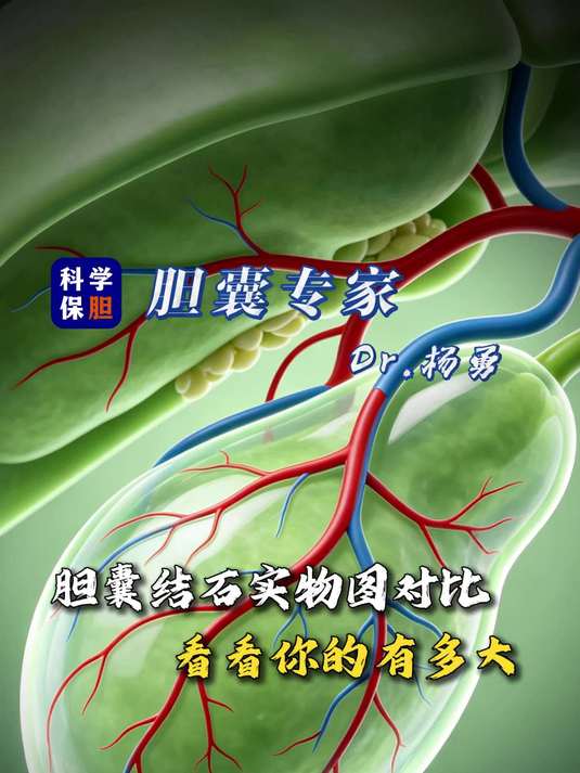 胆囊结石实物图参照，看看你的胆结石有多大