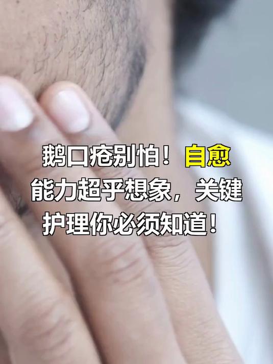 鹅口疮自己能好吗