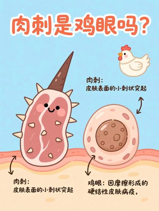肉刺是鸡眼吗
