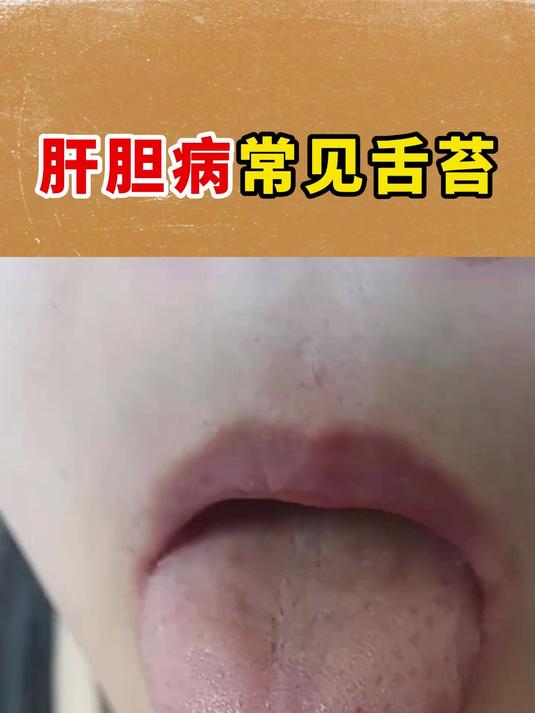 肝胆病常见舌苔,很多人都不知道,今天一个视频讲清楚