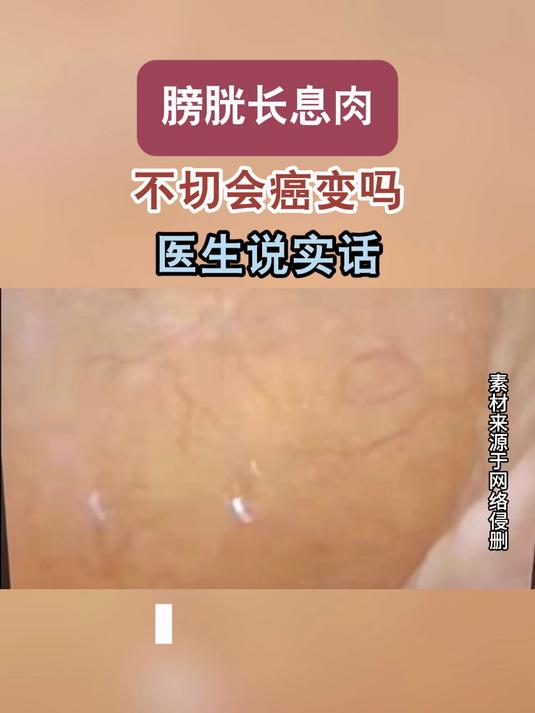 膀胱长息肉？不切会癌变吗？医生说实话#健康向阳计划#