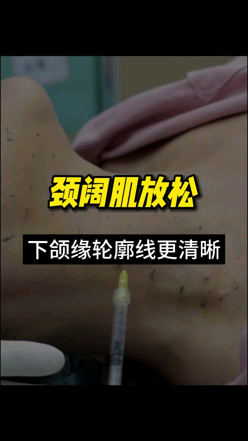 颈阔肌注射肉毒素,放松下拉的力量,让下颌缘轮廓更清晰。