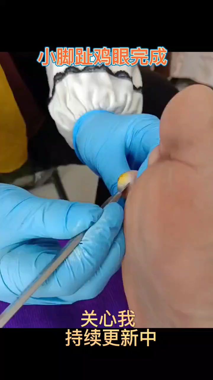 小脚趾长鸡眼