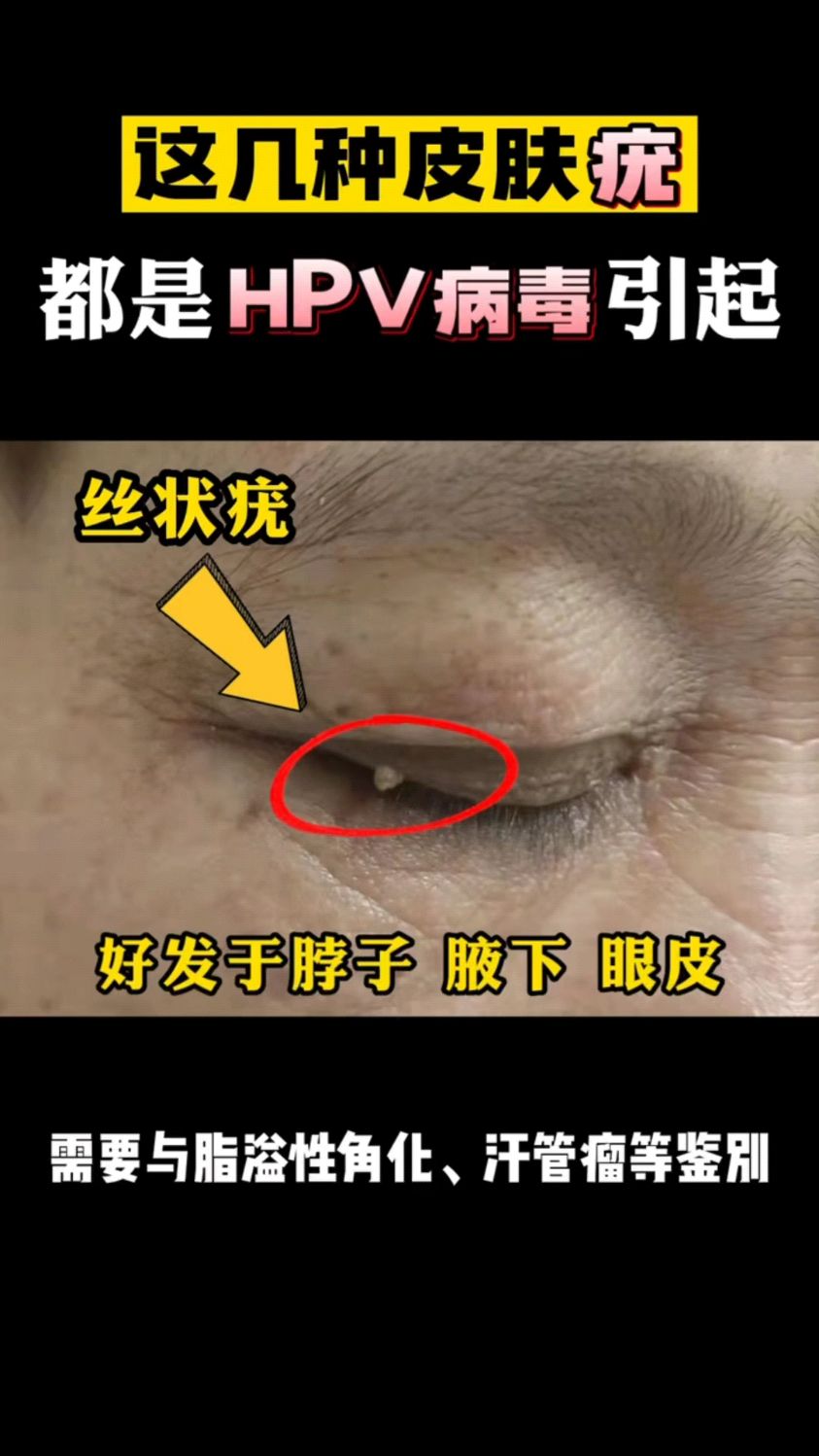 这几种皮肤疣都是HPV病毒引起的!
