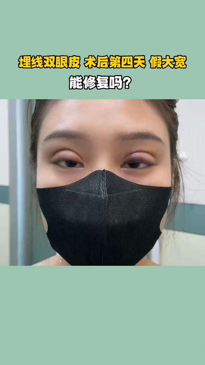 埋线双眼皮术后第四天假大款还能修复吗?
