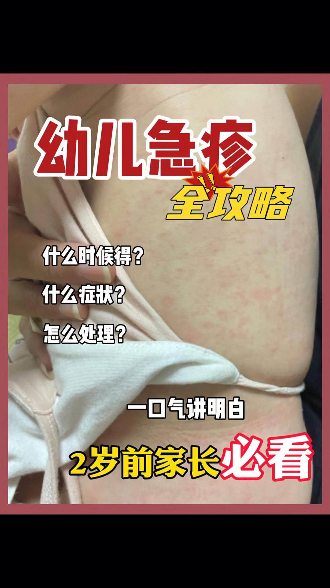幼儿急疹不要慌!3步跟我轻松度过