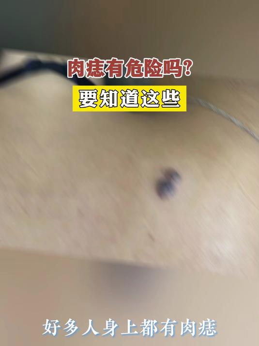 肉痣有危险吗?要知道这些