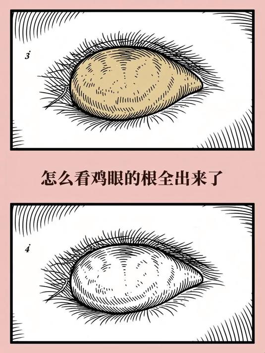 怎么看鸡眼的根全出来了 #健康扬帆季#