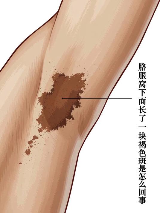 胳肢窝下面长了一块褐色斑是怎么回事 #健康扬帆季#