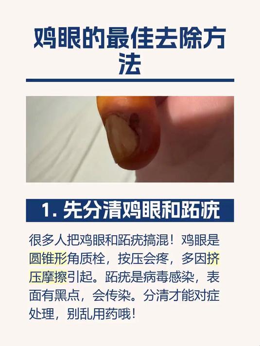 鸡眼的最佳去除方法