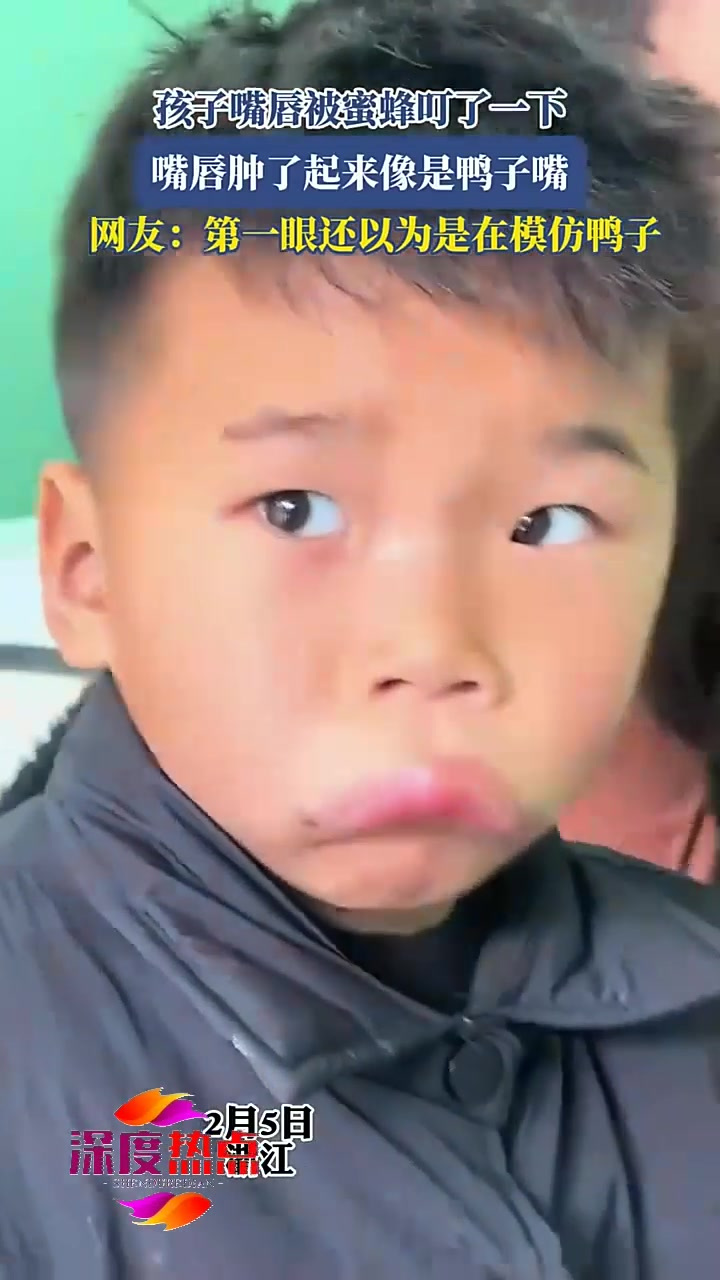 孩子嘴唇被蜜蜂叮了一下,嘴唇肿了起来像是鸭子嘴