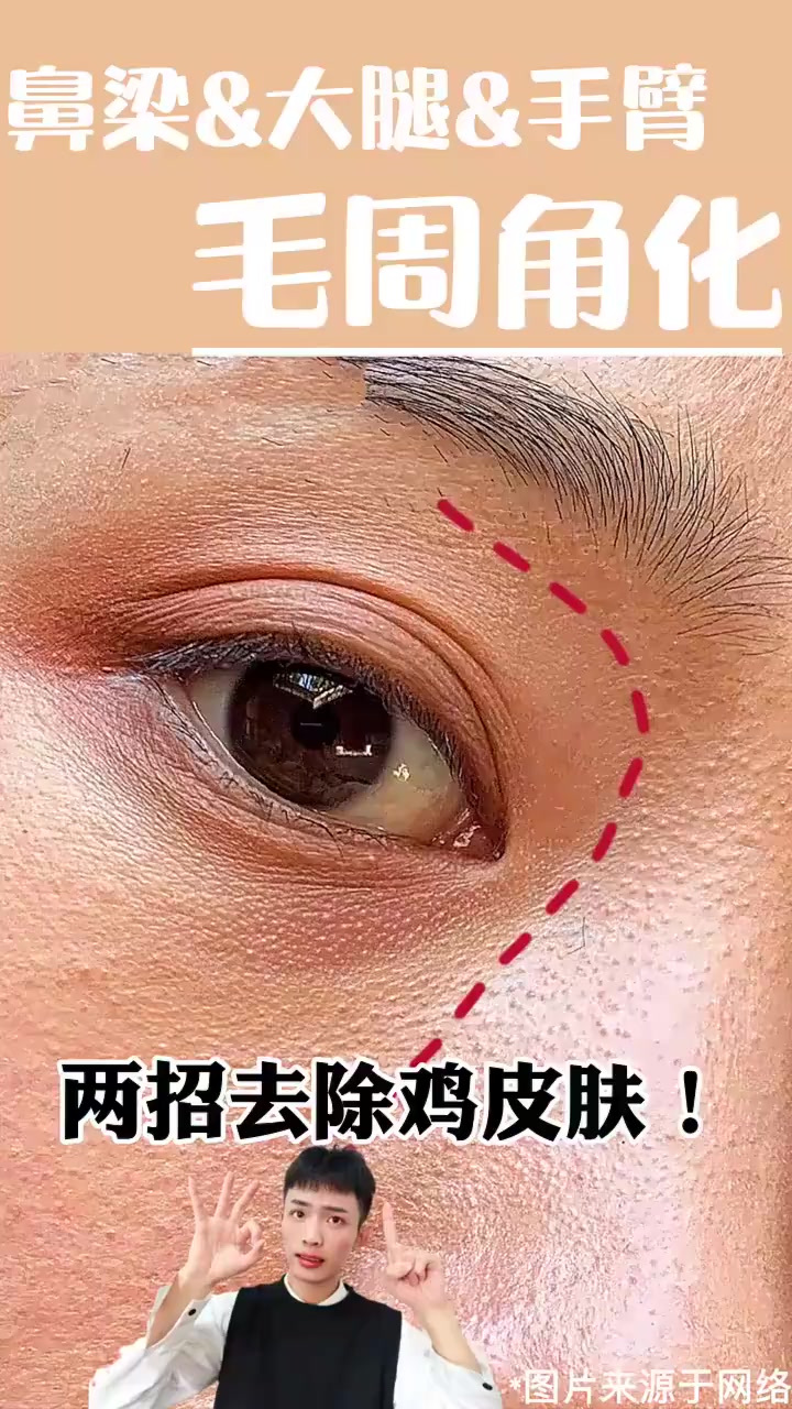 你有鸡皮肤毛周角化吗,那赶快把这期视频码住