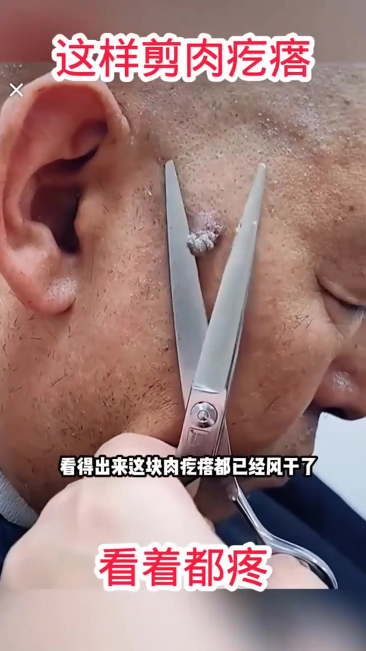 这样剪肉疙瘩,看着都疼!